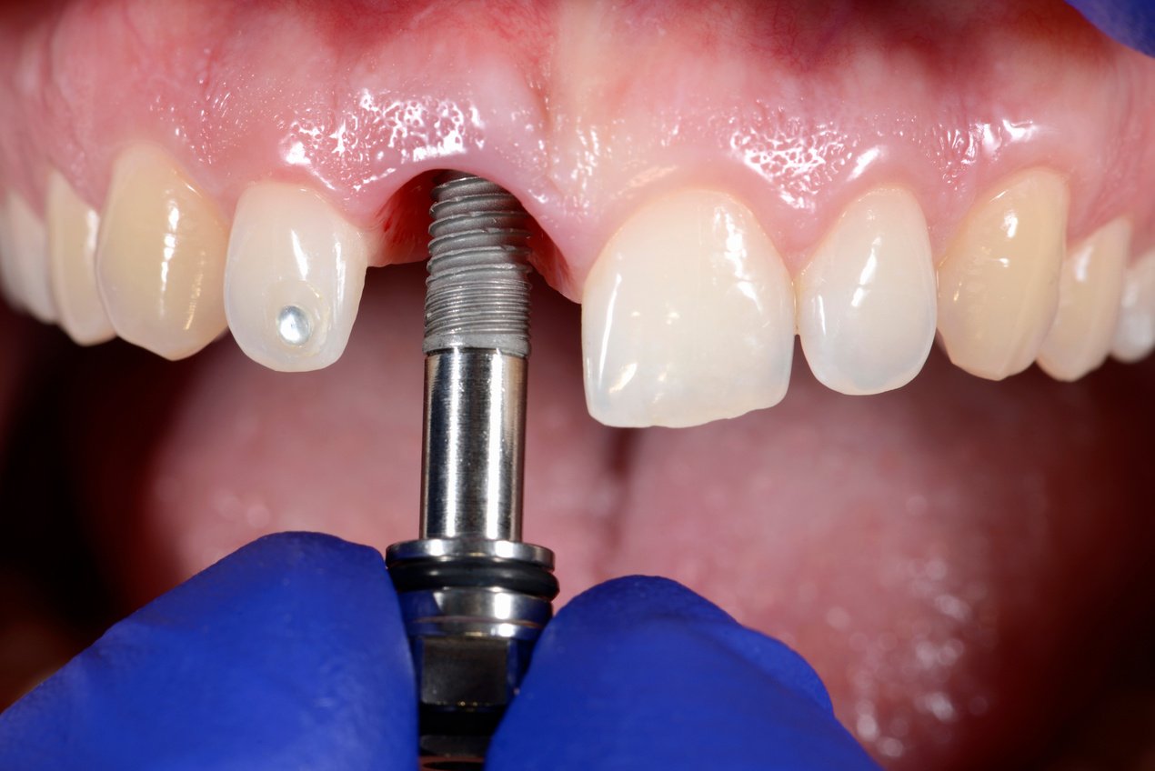 Dental Implant